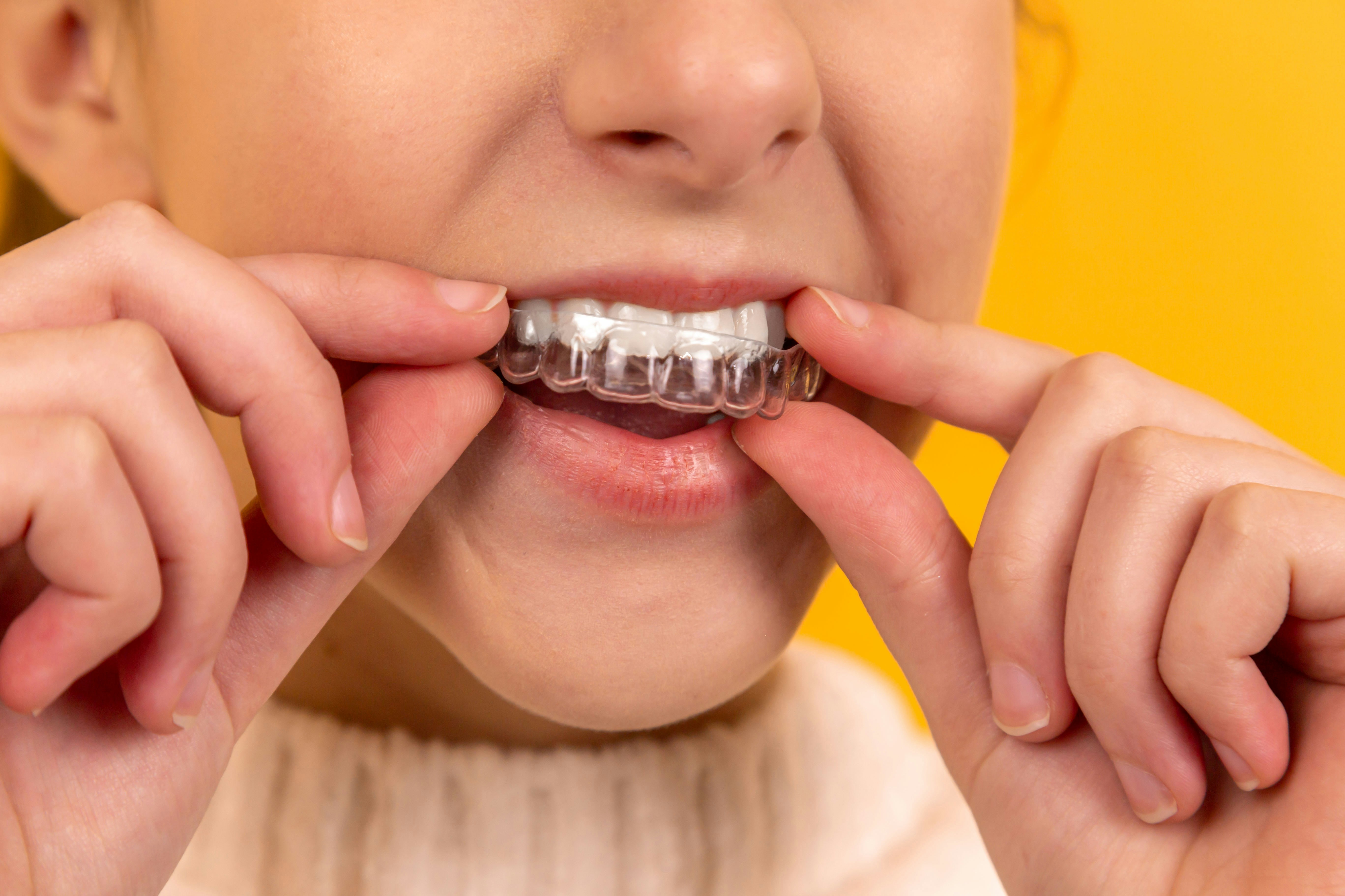 Clear aligners treatment planning