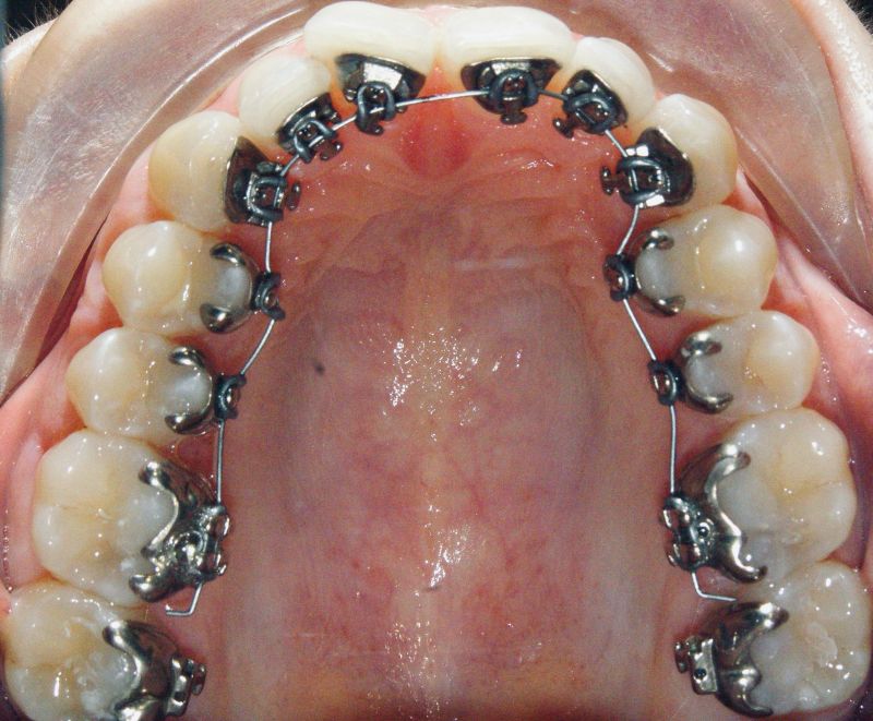 Lingual braces behind the teeth
