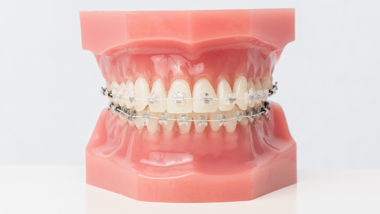 Self-ligating braces close-up