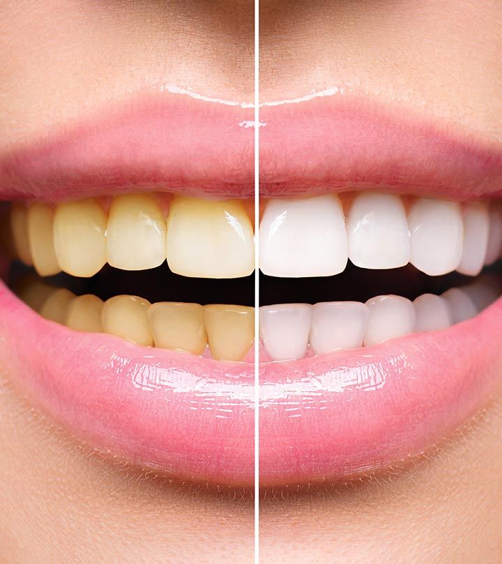Professional teeth whitening