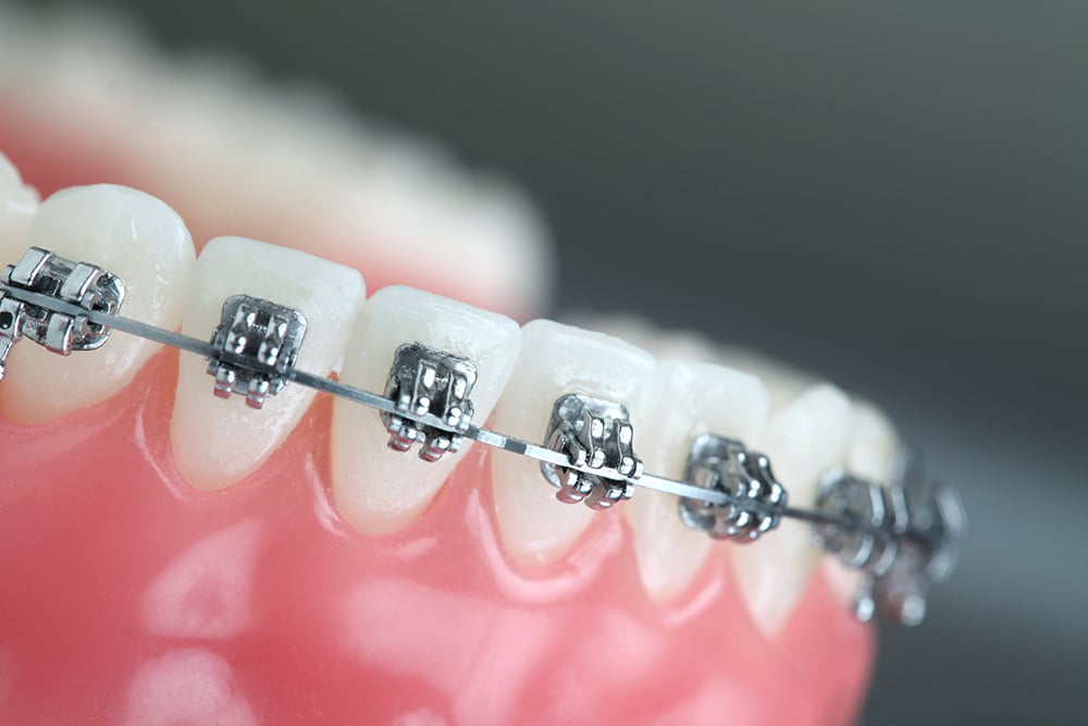 Traditional braces with precise archwires